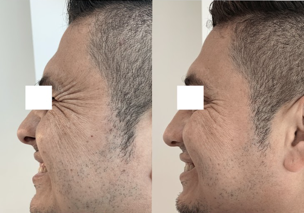 Antes y después aplicación de Botox - Dr. Eternal