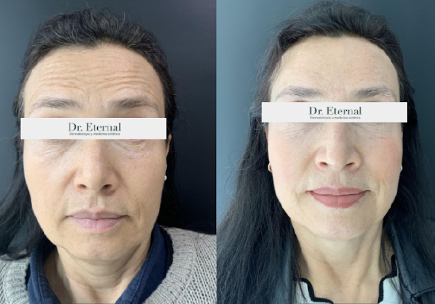 Antes y después aplicación de Botox - Dr. Eternal